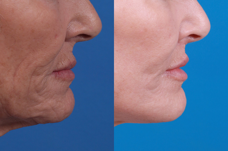 Lip Lift Before & After Gallery - Patient 122406908 - Image 3