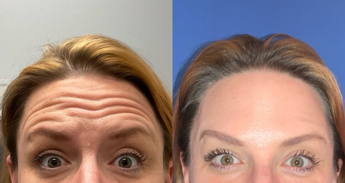 Botox Before & After Gallery - Patient 390081 - Image 1