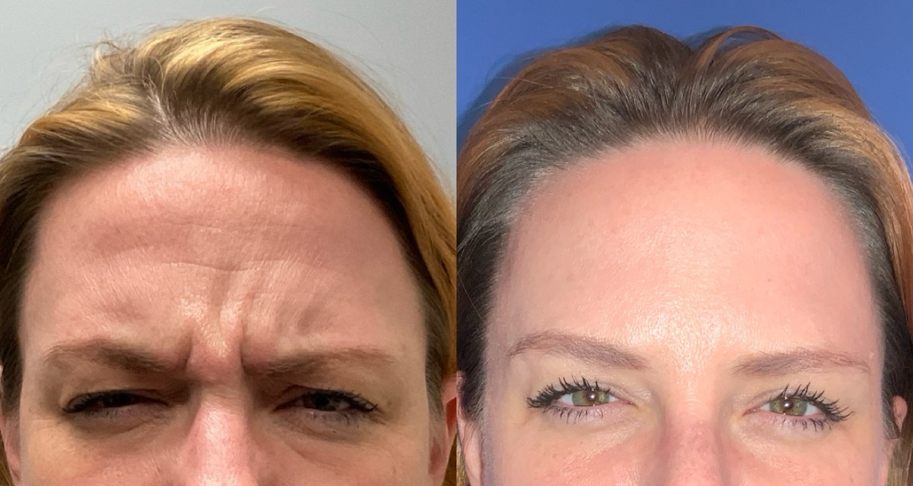 Botox Before & After Gallery - Patient 390081 - Image 2