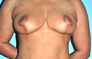 Breast Reduction Before & After Gallery - Patient 331742 - Image 2
