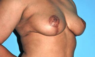 Breast Reduction Before & After Gallery - Patient 331742 - Image 4