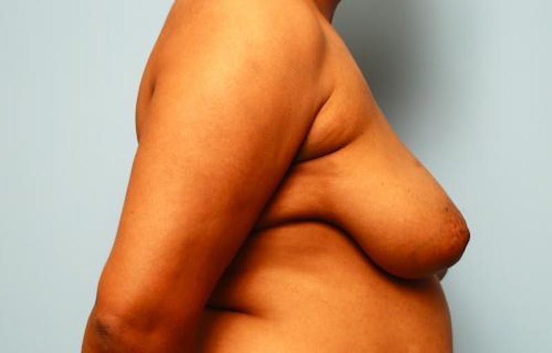 Breast Reduction Before & After Gallery - Patient 331742 - Image 5