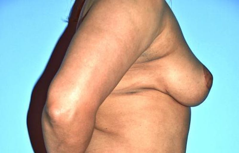 Breast Reduction Before & After Gallery - Patient 331742 - Image 6