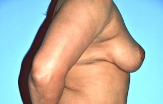 Breast Reduction Before & After Gallery - Patient 331742 - Image 6