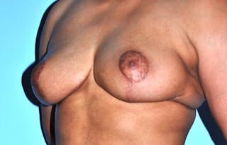 Breast Reduction Before & After Gallery - Patient 331742 - Image 8