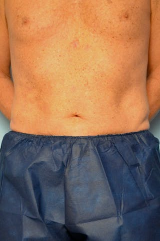 Liposuction Before & After Gallery - Patient 401824 - Image 2