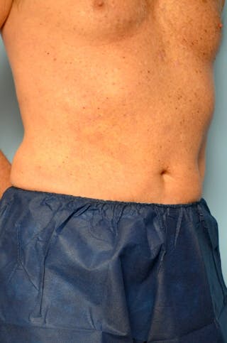 Liposuction Before & After Gallery - Patient 401824 - Image 4