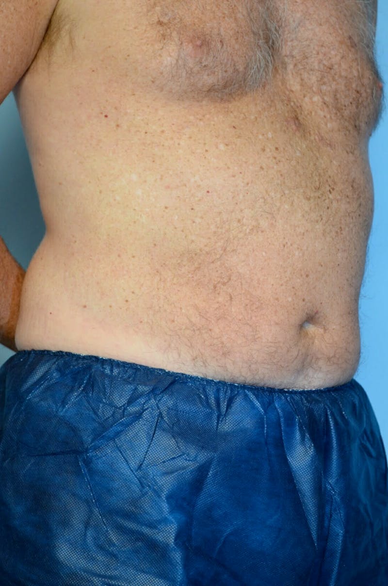 Liposuction Before & After Gallery - Patient 401824 - Image 3