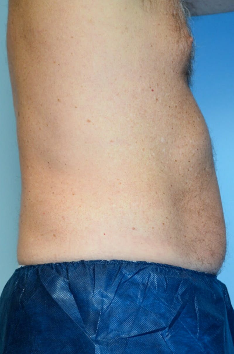 Liposuction Before & After Gallery - Patient 401824 - Image 5