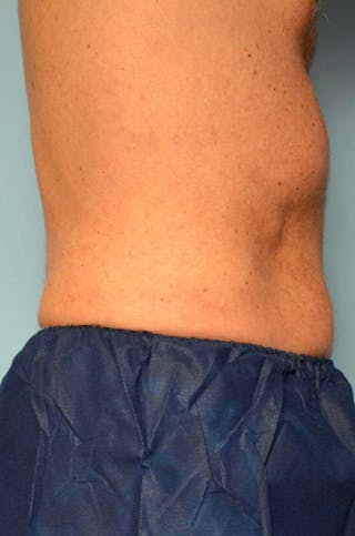 Liposuction Before & After Gallery - Patient 401824 - Image 6