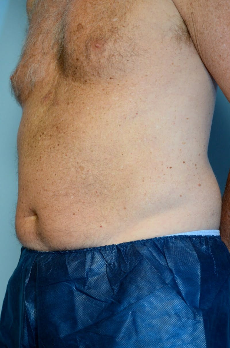 Liposuction Before & After Gallery - Patient 401824 - Image 7