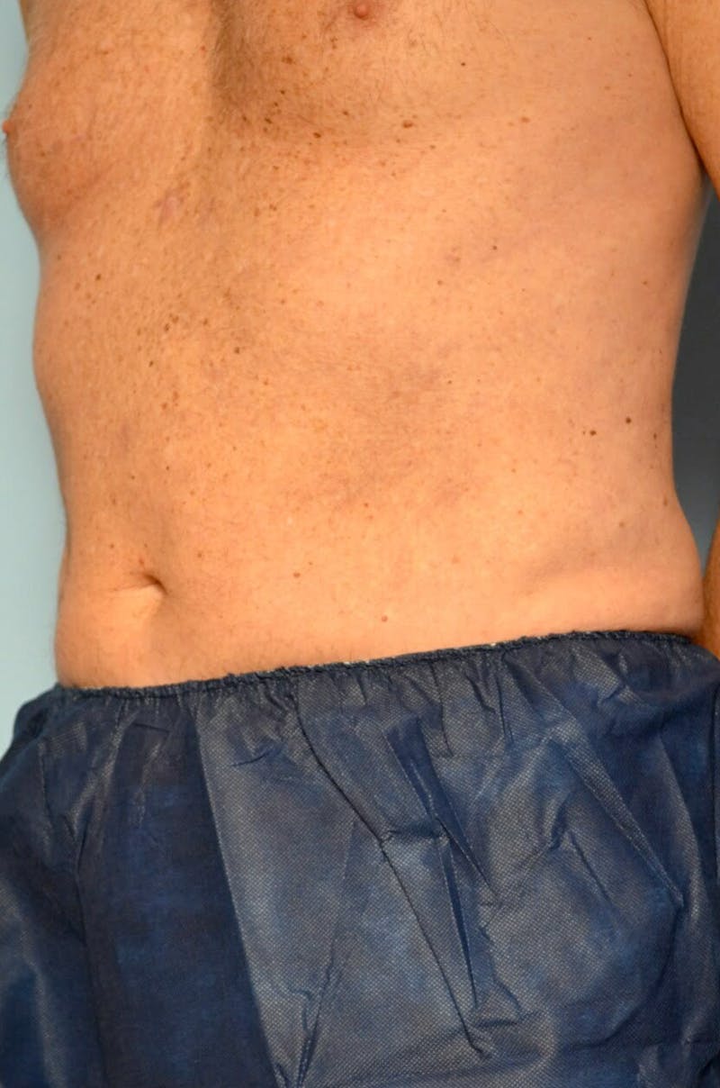Liposuction Before & After Gallery - Patient 401824 - Image 8