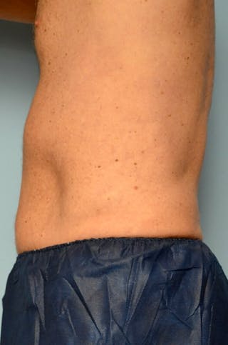 Liposuction Before & After Gallery - Patient 401824 - Image 10