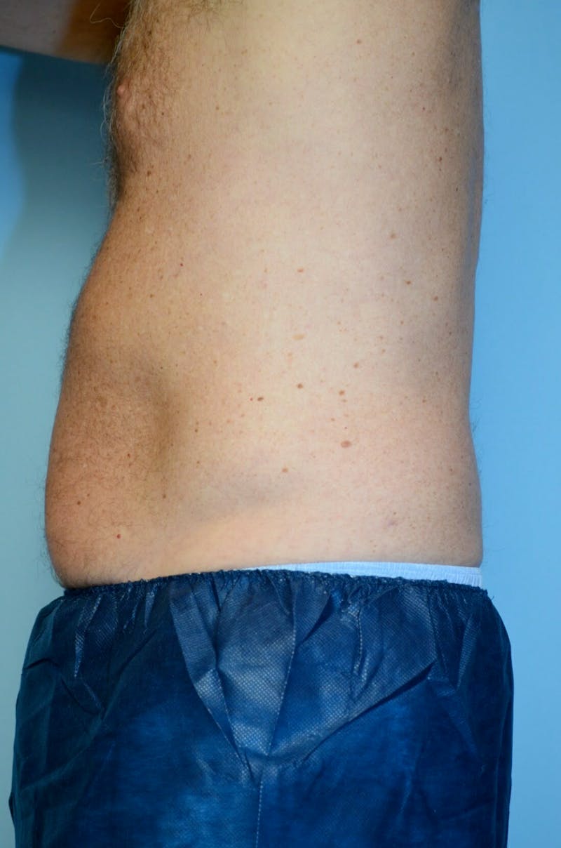 Liposuction Before & After Gallery - Patient 401824 - Image 9