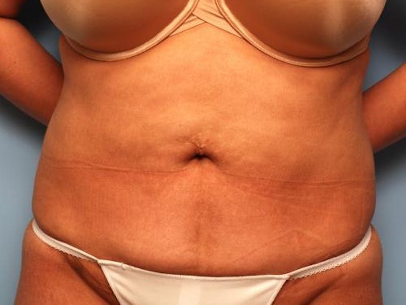 Liposuction Before & After Gallery - Patient 286459 - Image 2