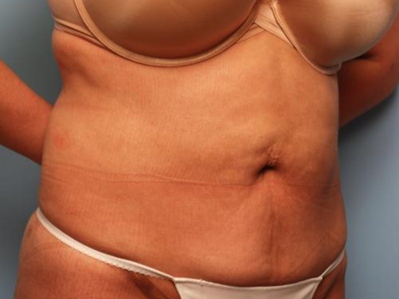 Liposuction Before & After Gallery - Patient 286459 - Image 4