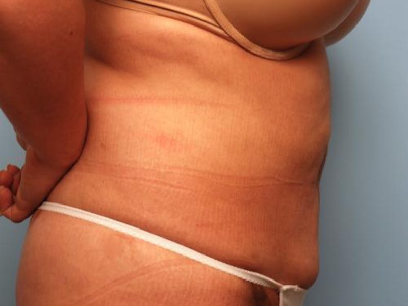 Liposuction Before & After Gallery - Patient 286459 - Image 6