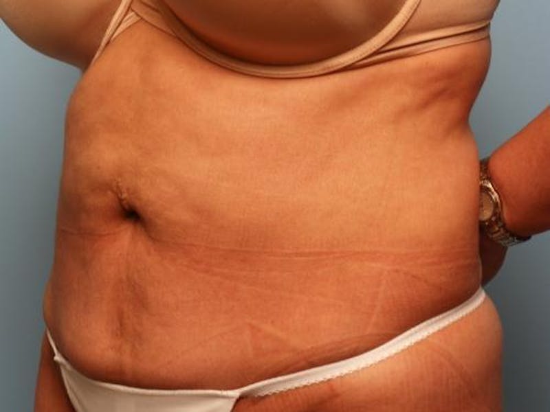 Liposuction Before & After Gallery - Patient 286459 - Image 8