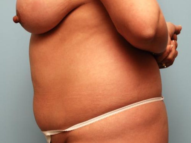 Liposuction Before & After Gallery - Patient 286459 - Image 9