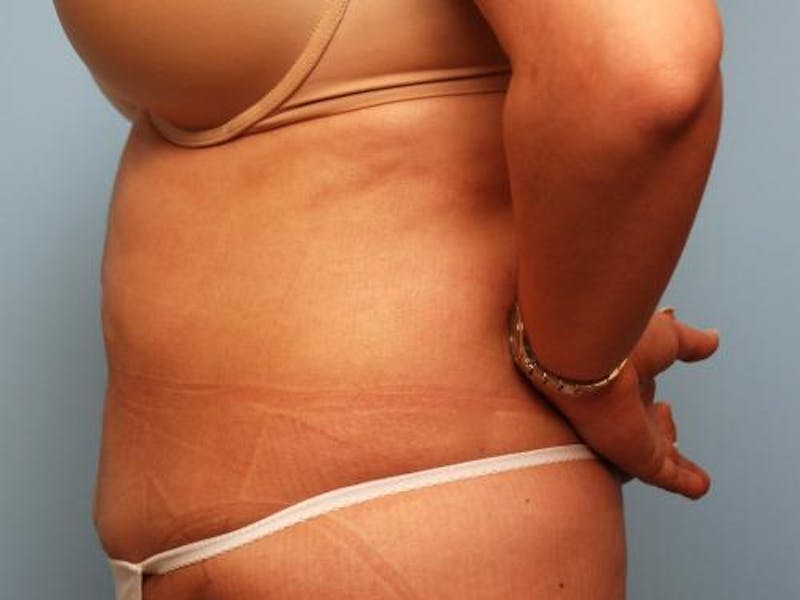 Liposuction Before & After Gallery - Patient 286459 - Image 10