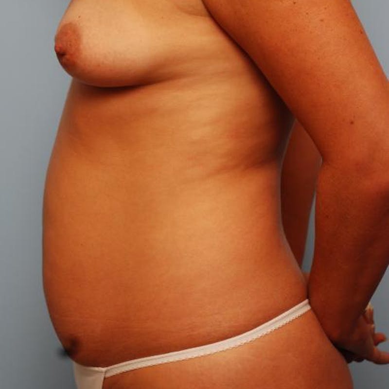 Mini Tummy Tuck Before & After Gallery - Patient 114089 - Image 9