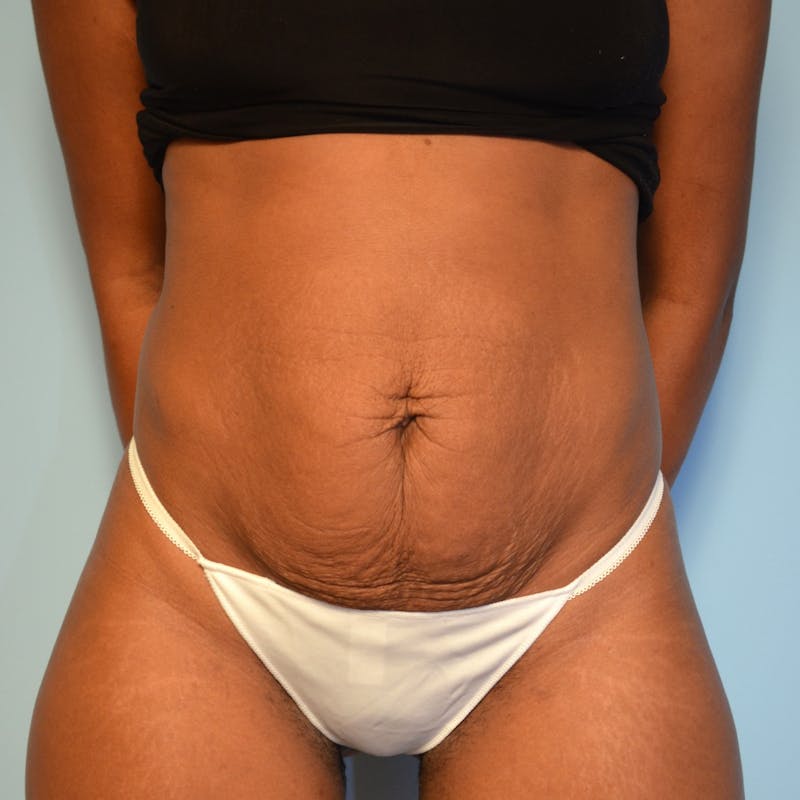 Tummy Tuck Before & After Gallery - Patient 335345 - Image 1