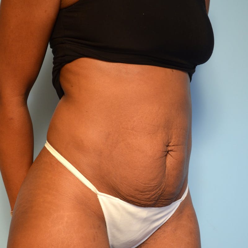 Tummy Tuck Before & After Gallery - Patient 335345 - Image 3