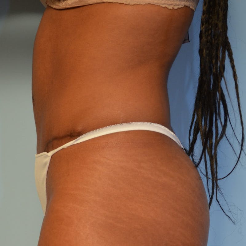 Tummy Tuck Before & After Gallery - Patient 335345 - Image 10