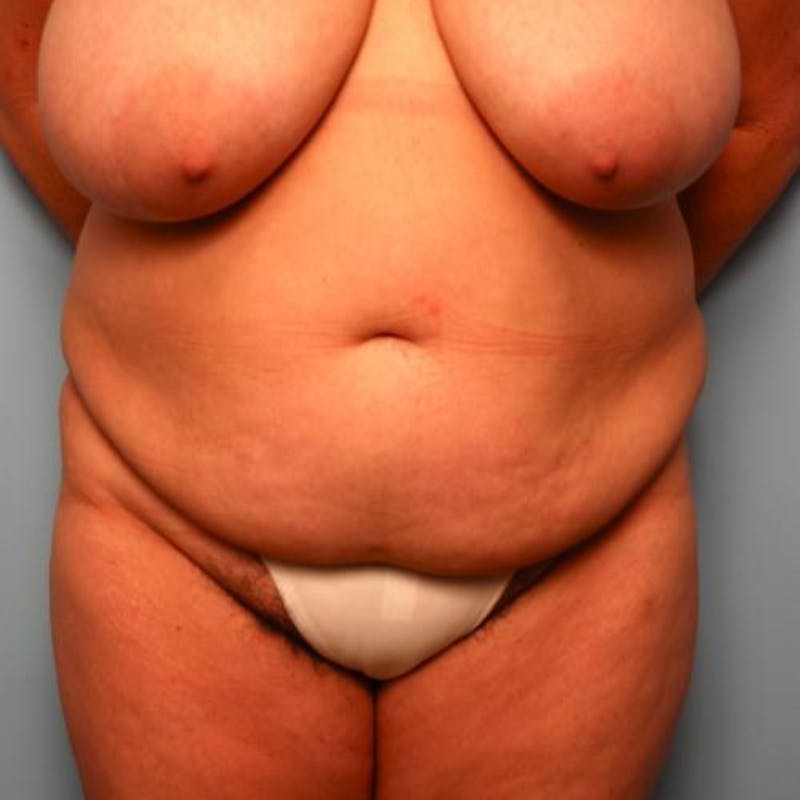 Tummy Tuck Before & After Gallery - Patient 177482 - Image 1