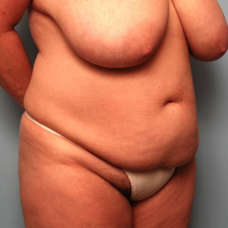 Tummy Tuck Before & After Gallery - Patient 177482 - Image 3