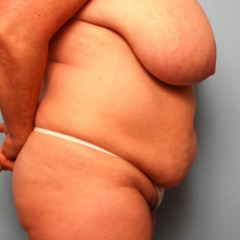 Tummy Tuck Before & After Gallery - Patient 177482 - Image 5