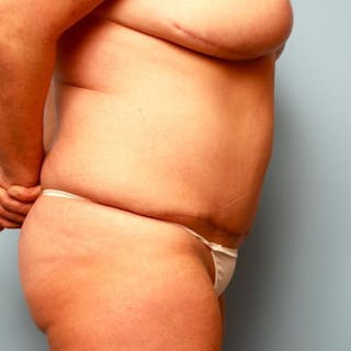 Tummy Tuck Before & After Gallery - Patient 177482 - Image 6
