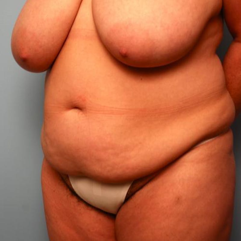 Tummy Tuck Before & After Gallery - Patient 177482 - Image 7