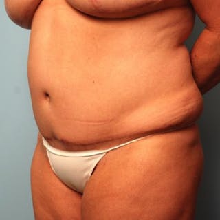 Tummy Tuck Before & After Gallery - Patient 177482 - Image 8