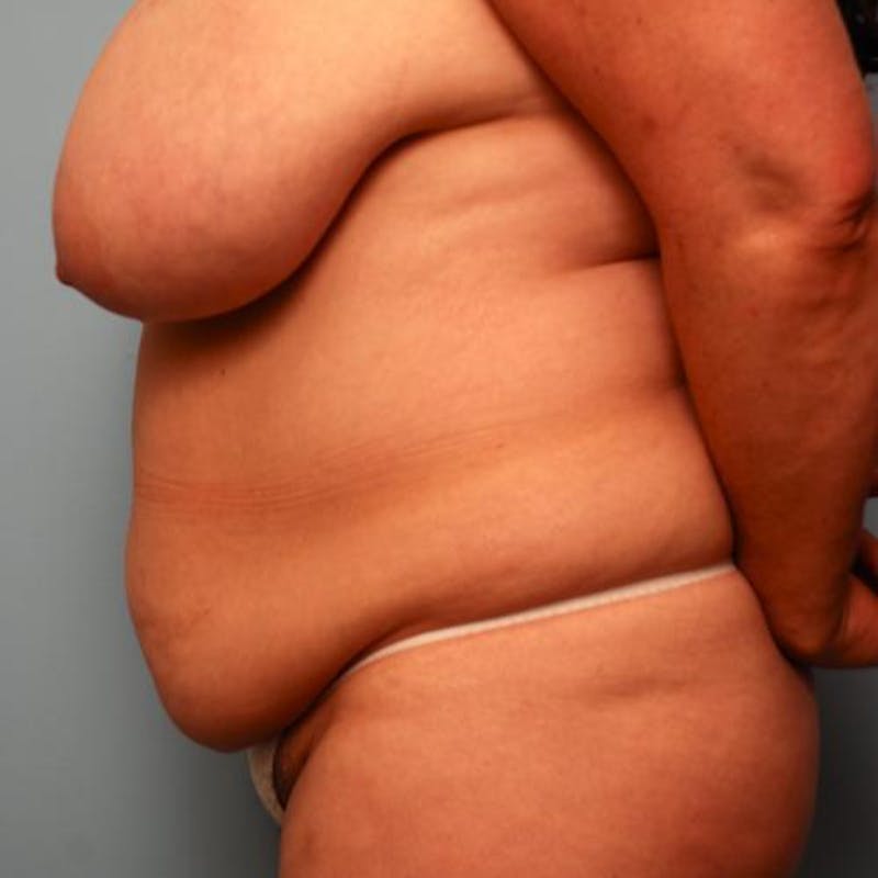 Tummy Tuck Before & After Gallery - Patient 177482 - Image 9