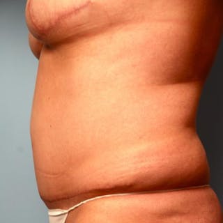 Tummy Tuck Before & After Gallery - Patient 177482 - Image 10