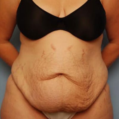 Tummy Tuck Before & After Gallery - Patient 421057 - Image 1