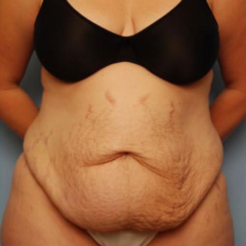 Tummy Tuck Before & After Gallery - Patient 421057 - Image 1