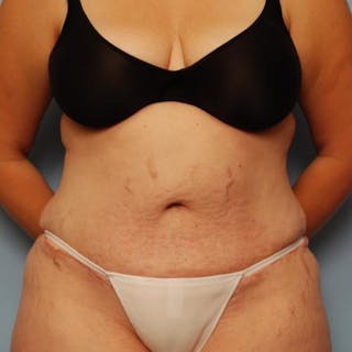 Tummy Tuck Before & After Gallery - Patient 421057 - Image 2