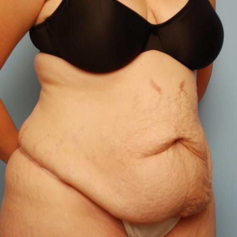 Tummy Tuck Before & After Gallery - Patient 421057 - Image 3