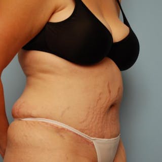Tummy Tuck Before & After Gallery - Patient 421057 - Image 4