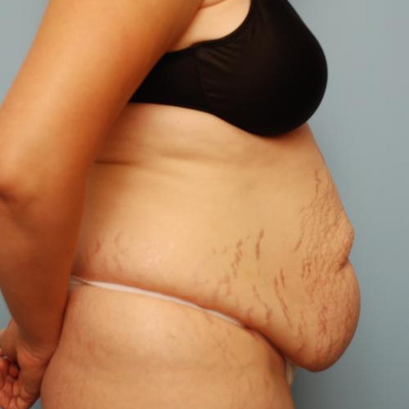 Tummy Tuck Before & After Gallery - Patient 421057 - Image 5
