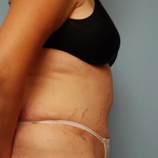Tummy Tuck Before & After Gallery - Patient 421057 - Image 6