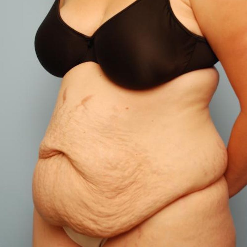 Tummy Tuck Before & After Gallery - Patient 421057 - Image 7