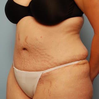 Tummy Tuck Before & After Gallery - Patient 421057 - Image 8