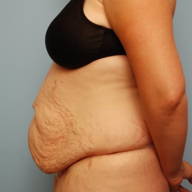 Tummy Tuck Before & After Gallery - Patient 421057 - Image 9