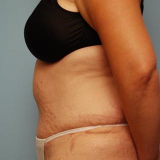 Tummy Tuck Before & After Gallery - Patient 421057 - Image 10