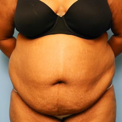 Tummy Tuck Before & After Gallery - Patient 105514 - Image 1