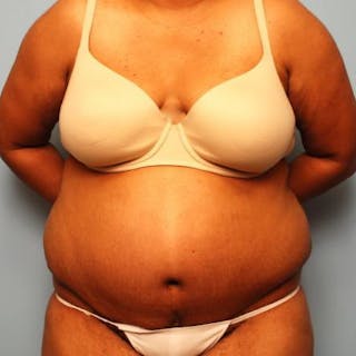 Tummy Tuck Before & After Gallery - Patient 105514 - Image 2