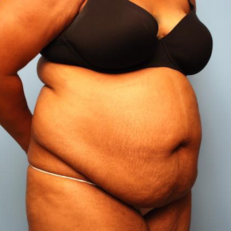 Tummy Tuck Before & After Gallery - Patient 105514 - Image 3